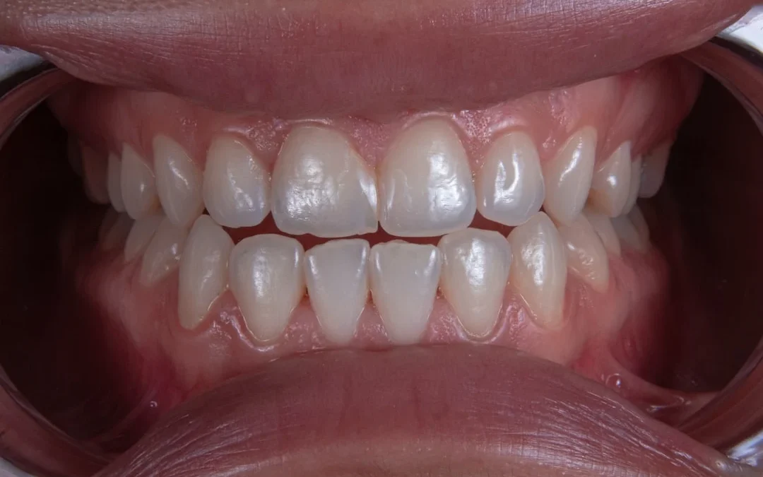 Braces vs. Clear Aligners: Which Is Right for You?